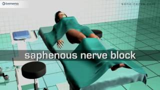 Saphenous nerve block [upl. by Ahsilahs]