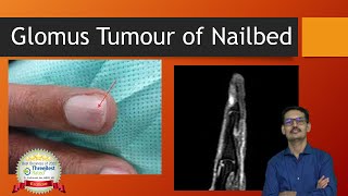 Glomus Tumor English Nailbed [upl. by Dustie]