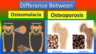 Difference Osteomalacia and Osteoporosis [upl. by Chrysler]