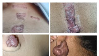 Effective Keloid Treatment Methods and Removal Techniques  Expert Advice keloidtreatment [upl. by Rosena]