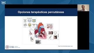 Webinar  Sistema Bicaval Tricvalve [upl. by Brause]