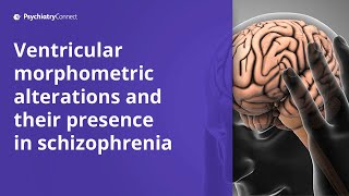 Ventricular Morphometrics Role in Early Stages of Schizophrenia [upl. by Onileva205]