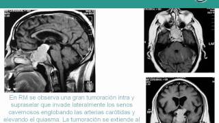 NeurorgsnetMacroadenoma de Hipófisis [upl. by Engel126]