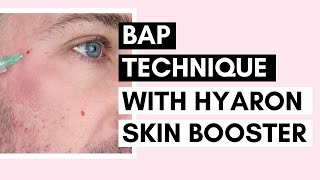 Mesotherapy for Glowing Skin  BAP Technique with Hyaron Skin Booster Ft Vanidiy [upl. by Umberto]