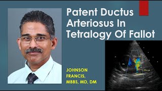 Patent Ductus Arteriosus In Tetralogy Of Fallot [upl. by Melody]