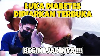 LUKA DIABETES DIBIARKAN TERBUKA SELAMA HAMPIR 1 BULAN ❗LUKA INFEKSI LUKA DIABETES [upl. by Alcine]