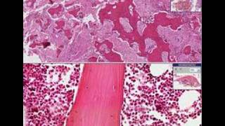 Histopathology BonePaget disease [upl. by Helm612]