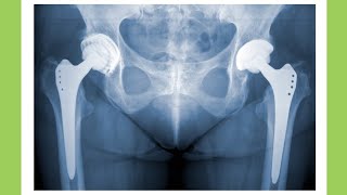 What is Hip Arthroplasty  shorts [upl. by Ahsaf]