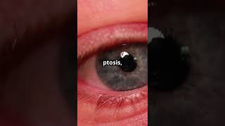 HornersSyndrome Neurology medicaleducation medicalstudent  DiagnosticLens [upl. by Sylirama]