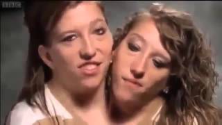 Abby and Brittany Joined for Life Episode 5 BBC Three 25 01 2014 [upl. by Hauser]