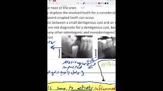 Odontogenic cysts 1 part 1 [upl. by Haywood52]