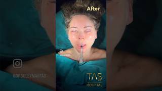 Scarless facelift and necklift blepharoplasty by DrTAS plasticsurgeon tasmedicalcenter [upl. by Irem]