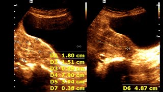 Multiple Fibroid Uterus  Leiomyoma of Uterus  Uterine Benign Tumor [upl. by Yticilef]