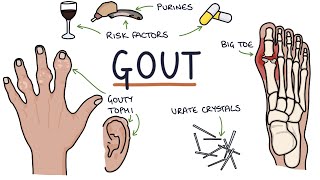 Gout Visual Explanation for Students [upl. by Cristabel523]