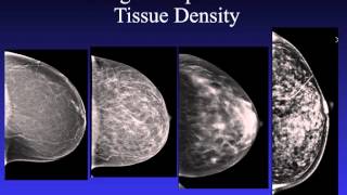 Introduction to Mammography [upl. by Benyamin]