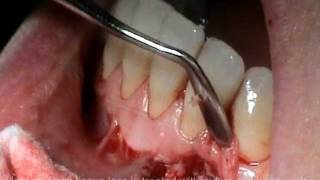 Atlanta Periodontist Georgia GA Cyst Removal Bone Grafting Surgery [upl. by Roley]