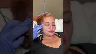 FACELIFT LIKE RESULTS IN MINUTES WITH PDO THREADS youtubeshorts pdothreadlift [upl. by Faubert516]