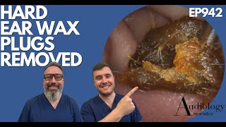 HARD EAR WAX PLUGS REMOVED  EP942 [upl. by Marashio]