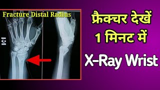 Fracture Distal Radius Case6  Wrist XRay  UdayXray [upl. by Aima821]