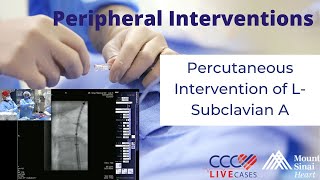 Percutaneous Intervention of LSubclavian A  June 26 2013 Live Case Video [upl. by Oiramd]