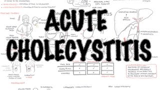 Acute Cholecystitis  Overview signs and symptoms pathophysiology treatment [upl. by Nimajneb460]