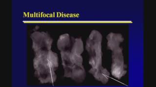 Breast Cancer Staging with Ultrasound [upl. by Manard]