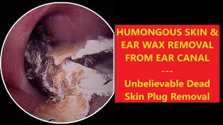 HUMONGOUS SKIN amp EAR WAX REMOVAL FROM EAR CANAL  EP70 relaxing satisfying asmr [upl. by Nahtanhoj]