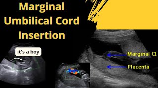 Ultrasound showing boy baby  with Marginal Umbilical Cord Insertion type [upl. by Dennard]