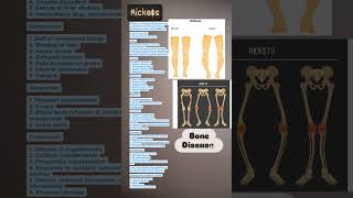 RICKETS bone disease medical medicaleducation [upl. by Singleton]