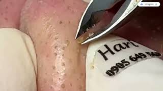 Blackheads Removal from the Nose with Haris  Satisfying [upl. by Eek69]