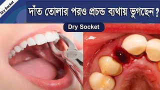 দাঁত তোলার পর প্রচন্ড ব্যথা হচ্ছে DRY SOCKET  Dat Tolar Por Betha  What Is Dry Socket In Bangla [upl. by Einama421]