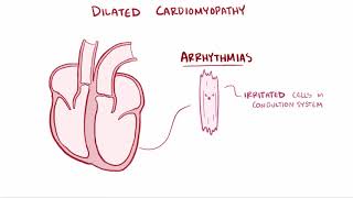 Dilated cardiomyopathy DCM causes symptoms diagnosis treatment amp pathology [upl. by Moreta]