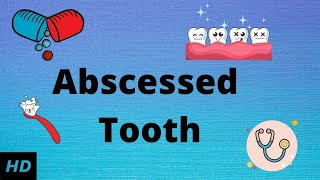 Abscessed tooth Causes SIgns and Symptoms Diagnosis and Treatment [upl. by Cutcheon]