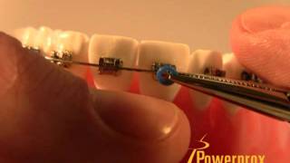 How to Tie an ORing Elastic Powerprox Six Month Braces Orthodontic Education Video [upl. by Nnaitsirhc291]