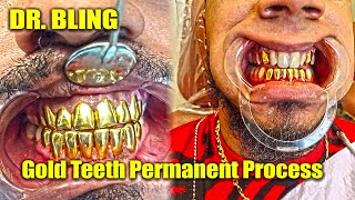 Gold Teeth Permanent Process  DR Bling [upl. by Esnohpla]