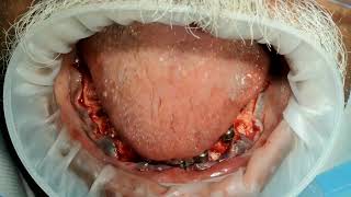 All on 6 with SMU bioline implants for periodontally compramised lower full jaw part 3 [upl. by Columbus]