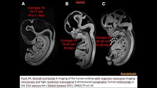 23 Posterior fossa  introductionoverview pontocerebellar hypoplasia Dandy Walker Blakes pouch [upl. by Pattison285]