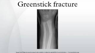 Greenstick fracture [upl. by Dyal603]