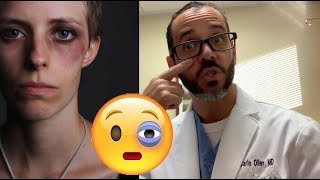 Black Eye  Patient Education Video  Dr Carlo Oller [upl. by Aynatal]