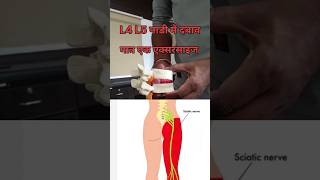 Sciatica pen nerve compression relief movement viralvideo trendingyoutube viral [upl. by Novyak]