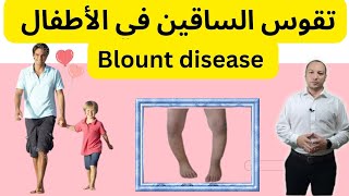 تقوس الساقين في الأطفالمرض بلاونتgenu varum  blount disease [upl. by Petronilla]