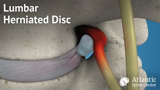 Lumbar Herniated Disc Overview [upl. by Nievelt896]