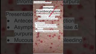 Immune thrombocytopenia [upl. by Airlia]