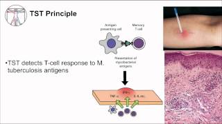 Tuberculosis Diagnosis [upl. by Synned]