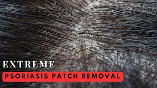 Psoriasis Patch Removal [upl. by Ennaeel]