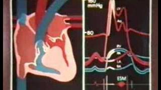 17  Idiopathische hypertrophe Subaortenstenose [upl. by Alolomo]