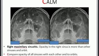 Sinusitis X ray [upl. by Lona]