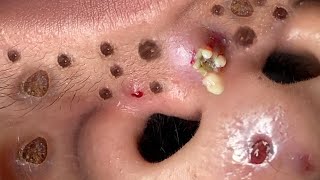 Blackhead Removal With Sac Dep Spa 100074089 [upl. by Josephson416]