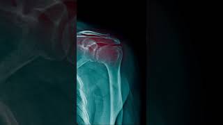 Rotator Cuff Tendinopathy l Tendonitis Best Exercises for Shoulder Pain Relief  shorts [upl. by Akeber]