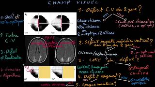 Champ visuel  Docteur Synapse [upl. by Aniz]